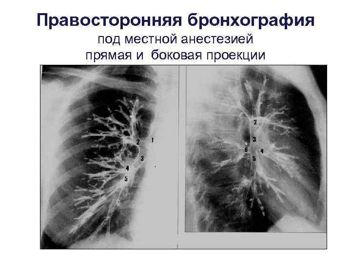 Правосторонняя бронхография  под местной анестезией прямая и боковая проекции 