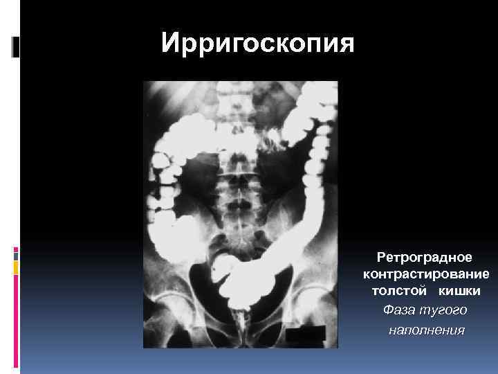 Ирригоскопия толстой кишки метод двойного контрастирования. Ирригоскопия. Двойное контрастирование толстой кишки. Ирригоскопия с контрастированием толстой кишки. Ирригоскопия (контрастирование кишечника).