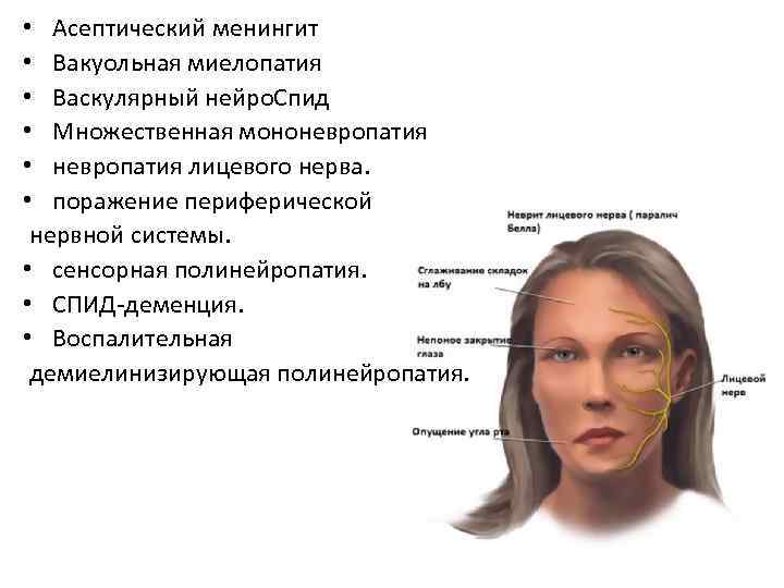  • Асептический менингит • Вакуольная миелопатия • Васкулярный нейро. Спид • Множественная мононевропатия