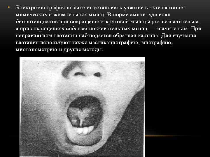  • Электромиография позволяет установить участие в акте глотания  мимических и жевательных мышц.