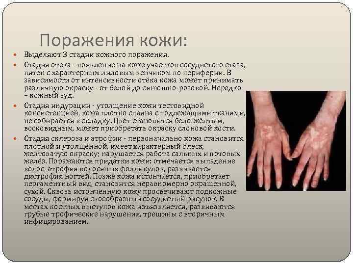  Поражения кожи:  Выделяют 3 стадии кожного поражения.  Стадия отека - появление