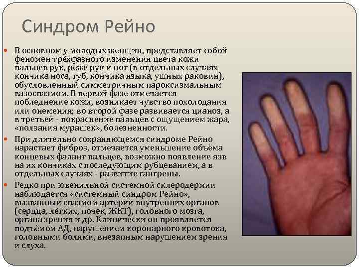   Синдром Рейно  В основном у молодых женщин, представляет собой  феномен
