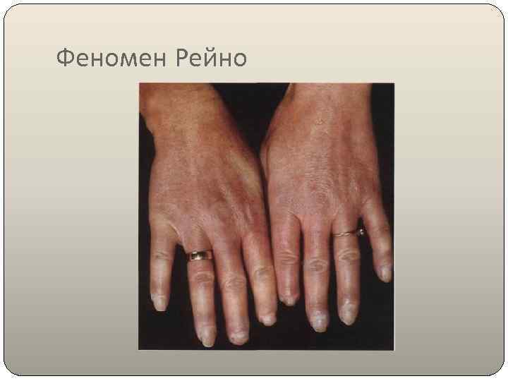 Феномен Рейно 