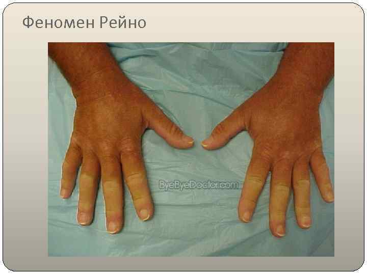 Феномен Рейно 