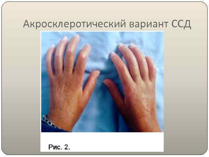 Акросклеротический вариант ССД 