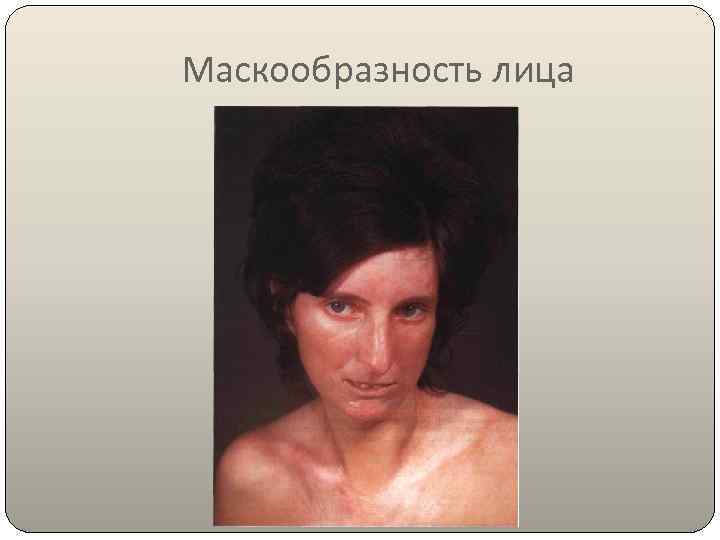 Маскообразность лица 