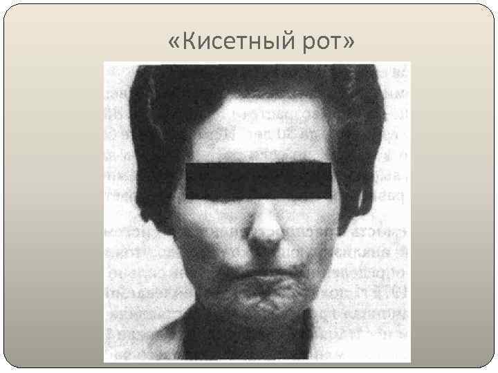  «Кисетный рот» 