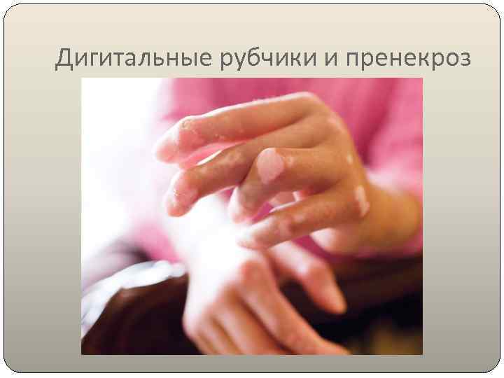 Дигитальные рубчики и пренекроз 
