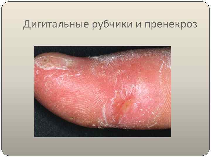 Дигитальные рубчики и пренекроз 