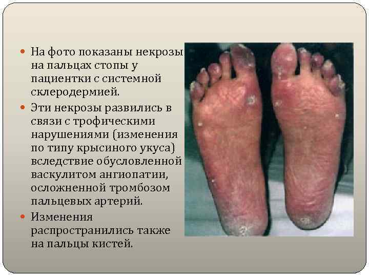  На фото показаны некрозы  на пальцах стопы у  пациентки с системной
