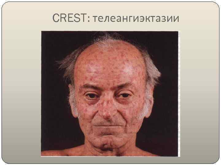 CREST: телеангиэктазии 