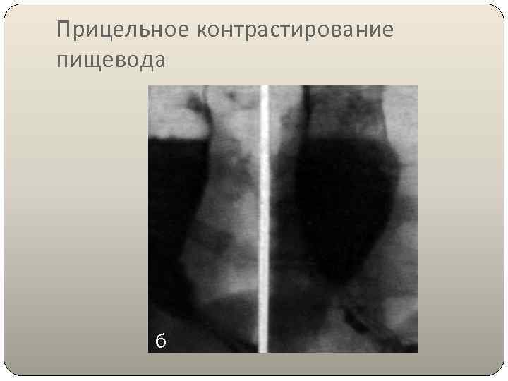 Прицельное контрастирование пищевода 