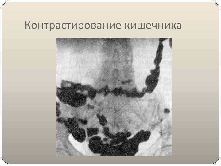 Контрастирование кишечника 