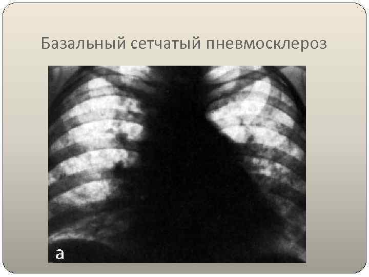 Базальный сетчатый пневмосклероз 