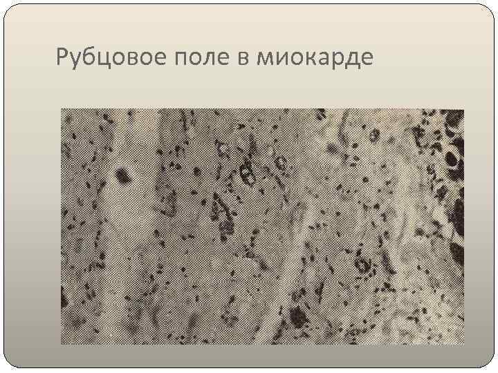 Рубцовое поле в миокарде 