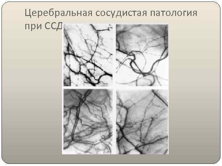 Церебральная сосудистая патология при ССД 