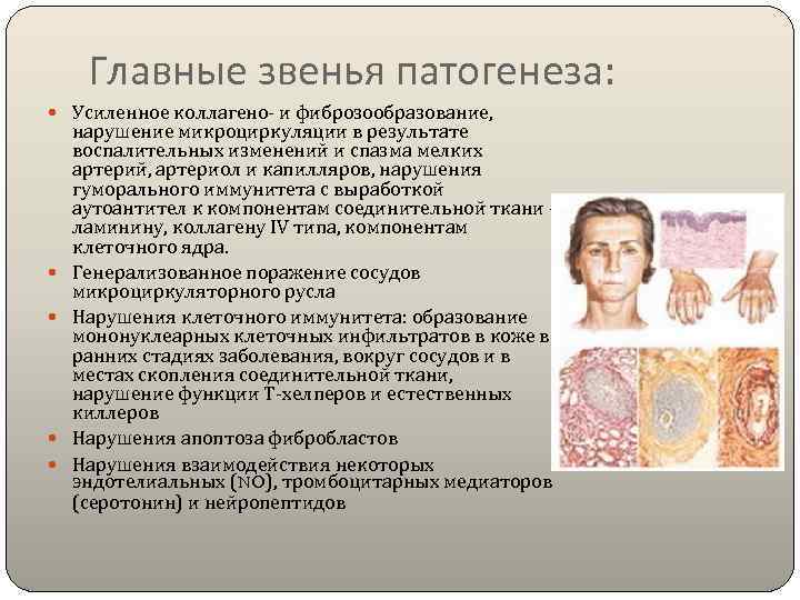  Главные звенья патогенеза:  Усиленное коллагено- и фиброзообразование,  нарушение микроциркуляции в результате