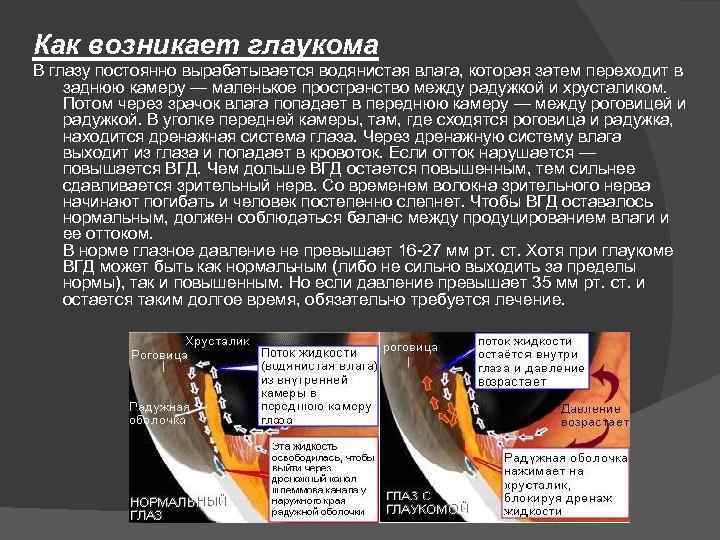 Как возникает глаукома В глазу постоянно вырабатывается водянистая влага, которая затем переходит в заднюю
