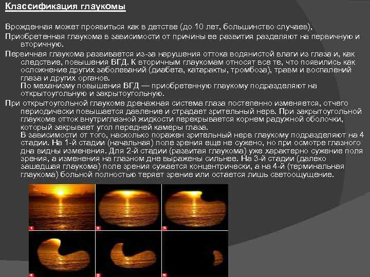 Классификация глаукомы Врожденная может проявиться как в детстве (до 10 лет, большинство случаев), Приобретенная