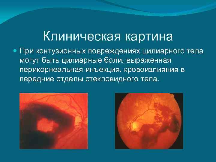   Клиническая картина  При контузионных повреждениях цилиарного тела  могут быть цилиарные