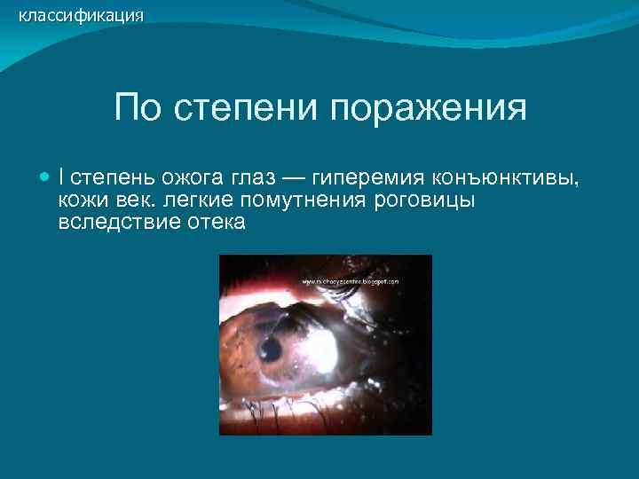 классификация   По степени поражения  I степень ожога глаз — гиперемия конъюнктивы,