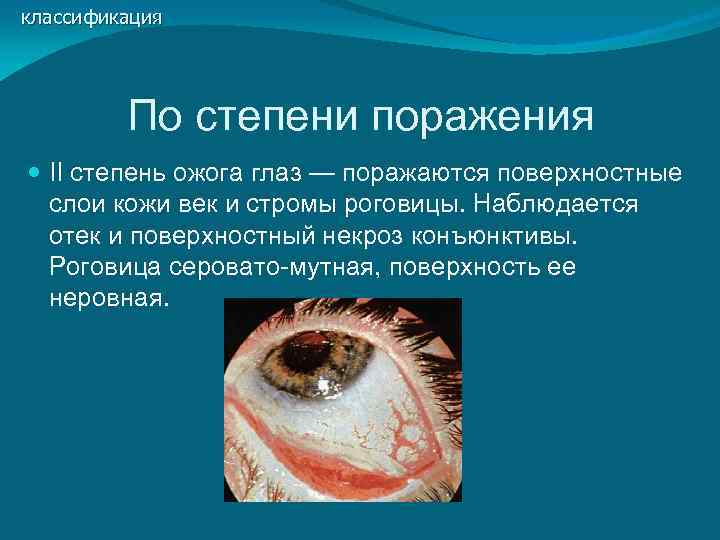 классификация   По степени поражения  II степень ожога глаз — поражаются поверхностные