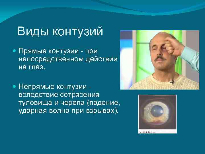  Виды контузий  Прямые контузии - при  непосредственном действии  на глаз.