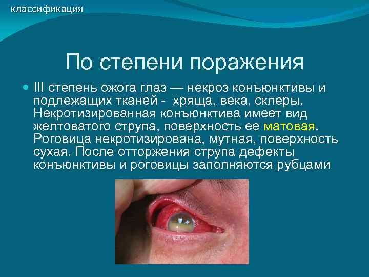 классификация   По степени поражения  III степень ожога глаз — некроз конъюнктивы