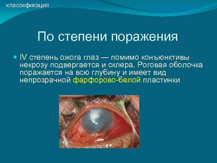 классификация   По степени поражения  IV степень ожога глаз — помимо конъюнктивы