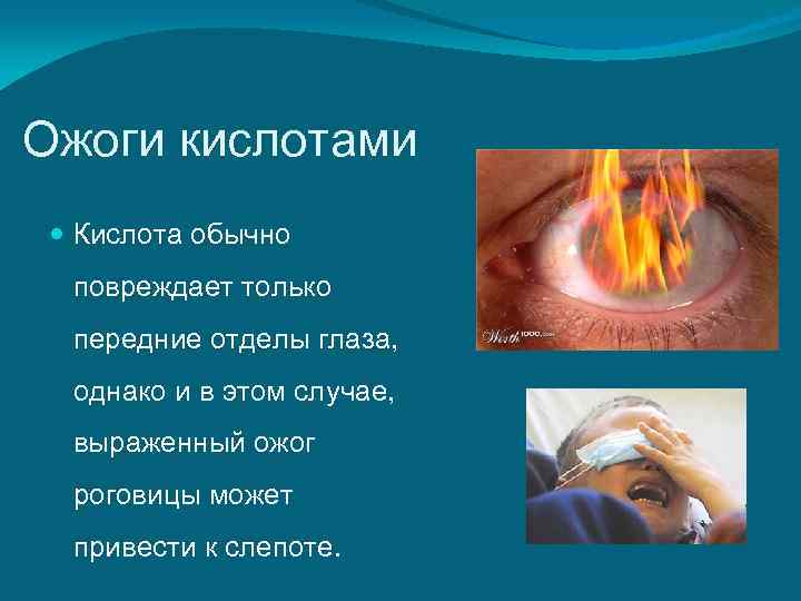 Ожоги кислотами  Кислота обычно  повреждает только  передние отделы глаза,  однако