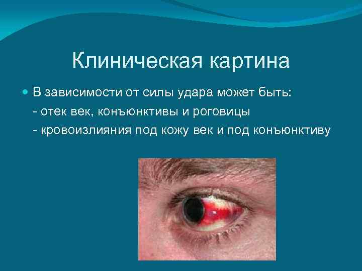   Клиническая картина  В зависимости от силы удара может быть:  -