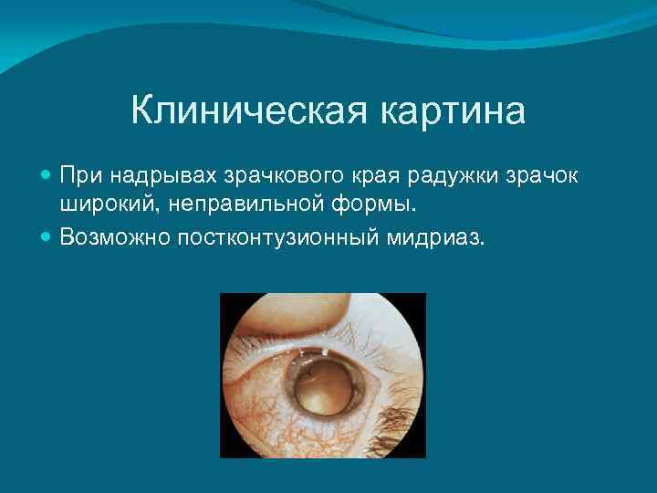  Клиническая картина  При надрывах зрачкового края радужки зрачок  широкий, неправильной