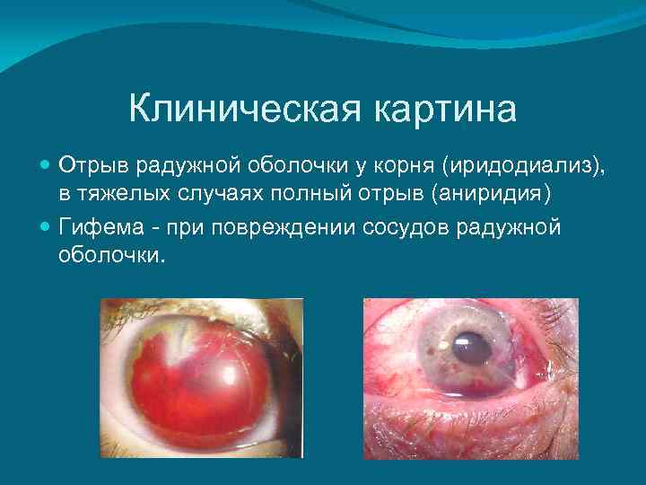   Клиническая картина  Отрыв радужной оболочки у корня (иридодиализ),  в тяжелых