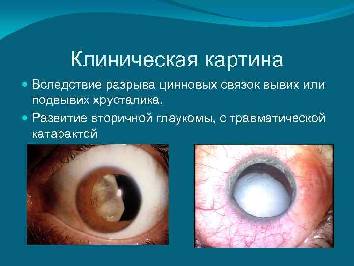   Клиническая картина  Вследствие разрыва цинновых связок вывих или  подвывих хрусталика.