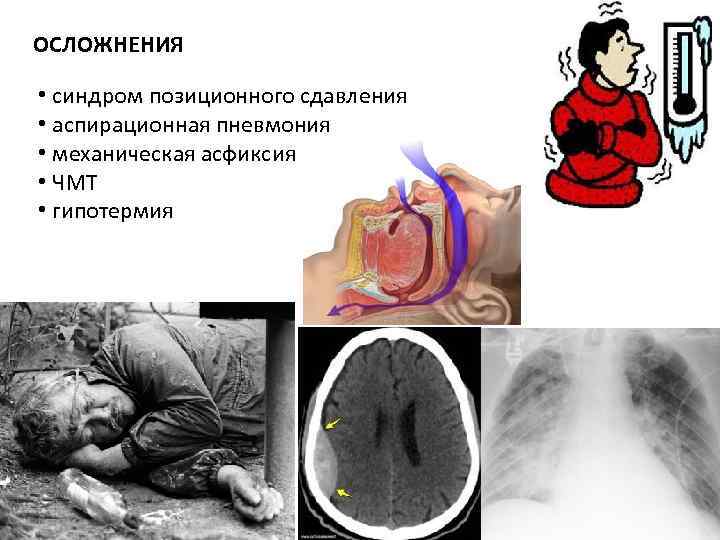 ОСЛОЖНЕНИЯ • синдром позиционного сдавления • аспирационная пневмония • механическая асфиксия • ЧМТ ОСЛОЖНЕНИЯ • синдром позиционного сдавления • аспирационная пневмония • механическая асфиксия • ЧМТ