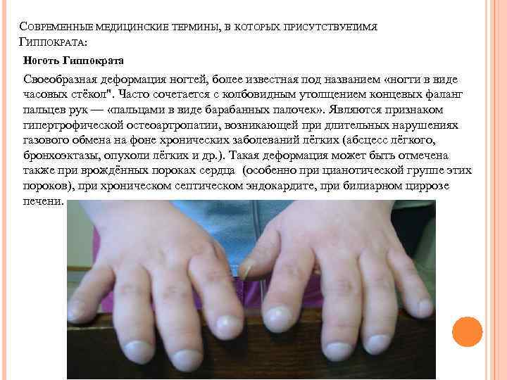 СОВРЕМЕННЫЕ МЕДИЦИНСКИЕ ТЕРМИНЫ, В КОТОРЫХ ПРИСУТСТВУЕТИМЯ      ГИППОКРАТА: Ноготь Гиппократа