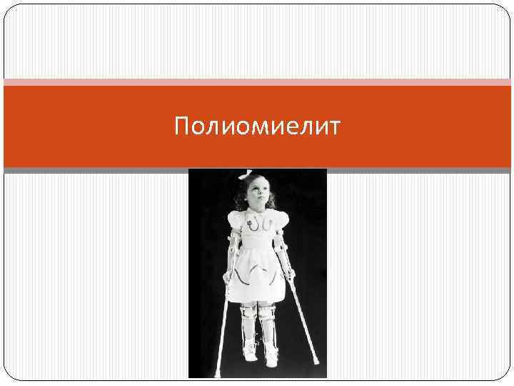Полиомиелит 