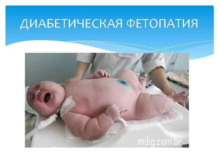 ДИАБЕТИЧЕСКАЯ ФЕТОПАТИЯ 