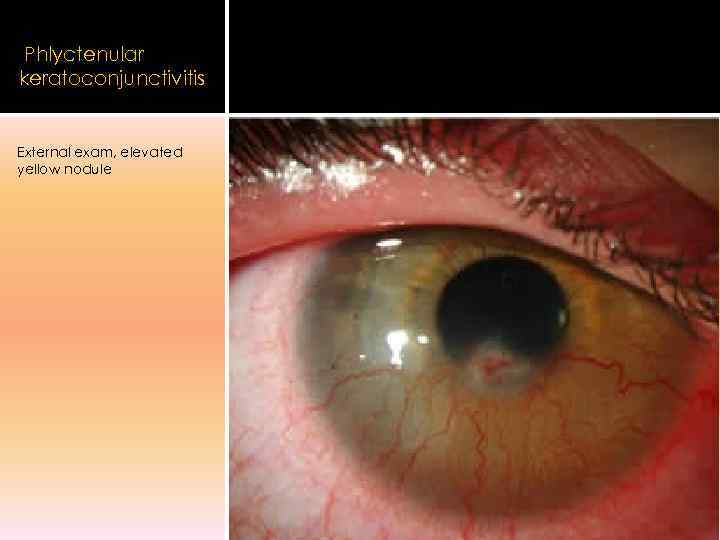 Phlyctenular keratoconjunctivitis  External exam, elevated yellow nodule 