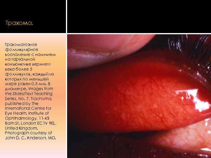 Трахома.  Трахоматозное фолликулярное воспаление с наличием на тарзальной конъюнктиве верхнего века более 5