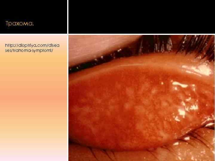 Трахома.  http: //dioptriya. com/disea ses/trahoma-symptomi/ 