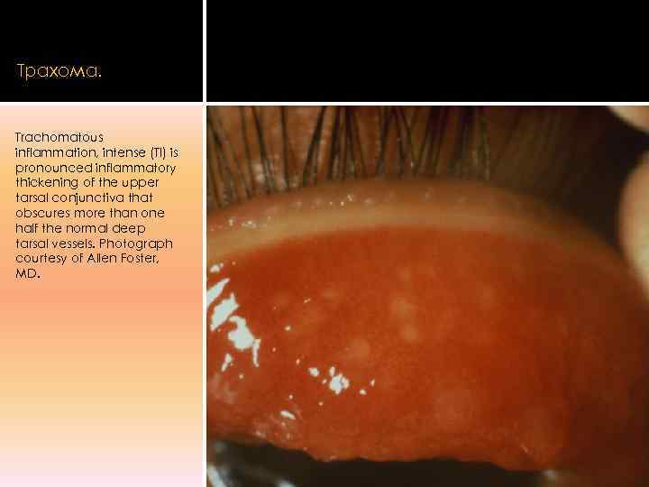 Трахома.  Trachomatous inflammation, intense (TI) is pronounced inflammatory thickening of the upper tarsal