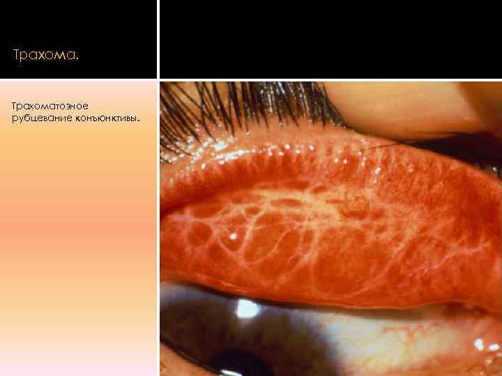 Трахома.  Трахоматозное рубцевание конъюнктивы. 