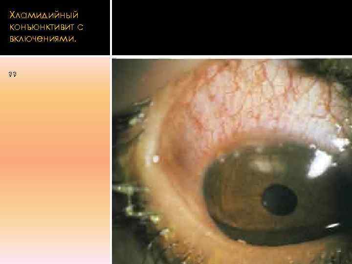 Хламидийный конъюнктивит с включениями.  ? ? 