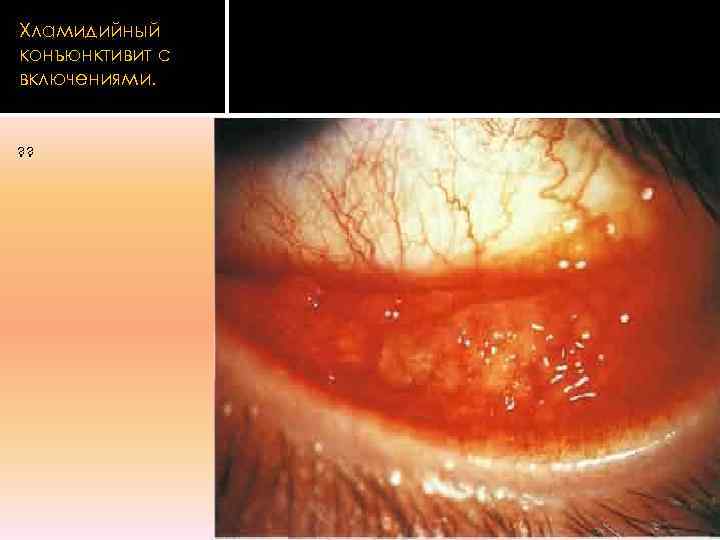 Хламидийный конъюнктивит с включениями.  ? ? 