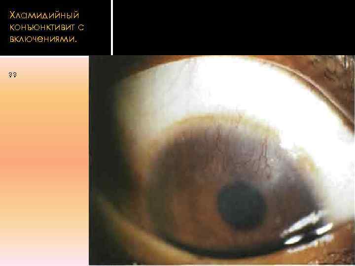 Хламидийный конъюнктивит с включениями.  ? ? 