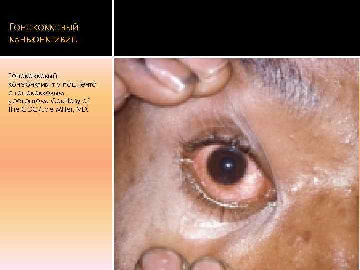 Гонококковый клнъюнктивит.  Гонококковый конъюнктивит у пациента с гонококковым уретритом. Courtesy of the CDC/Joe