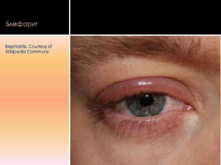 Блефарит  Blepharitis. Courtesy of Wikipedia Commons 