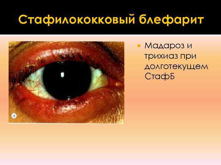 Стафилококковый блефарит     Мадароз и    трихиаз при 