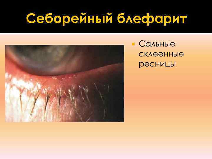 Себорейный блефарит   Сальные   склеенные   ресницы 